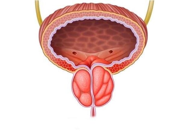 Inflammation de la prostate chez l'homme