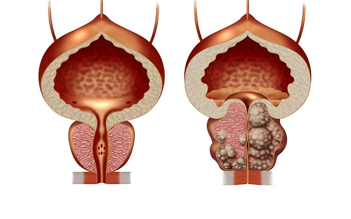 A quoi ressemble un adénome de la prostate 